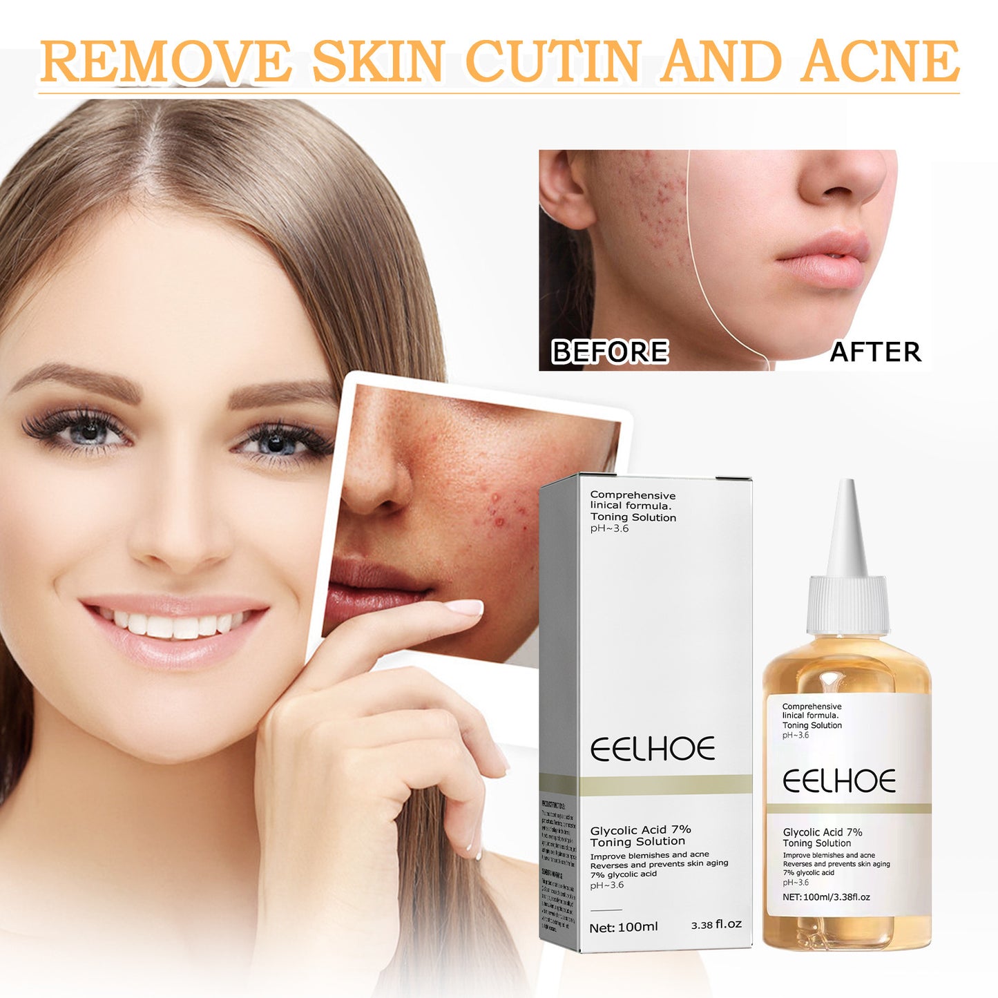 EELHOE Glycolic Acid 7 Lotion Acne Removing Closed Mouth